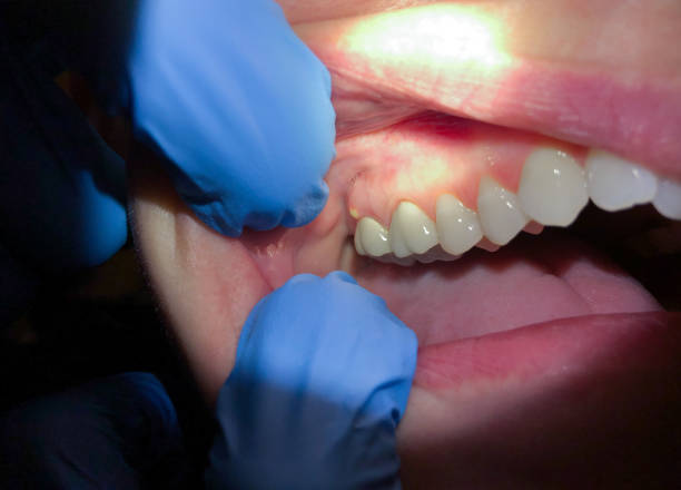 Best Knocked-Out Tooth Emergency  in Wright Patterson Af, OH